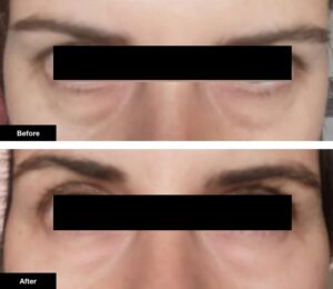 The EYE Serum Before/After